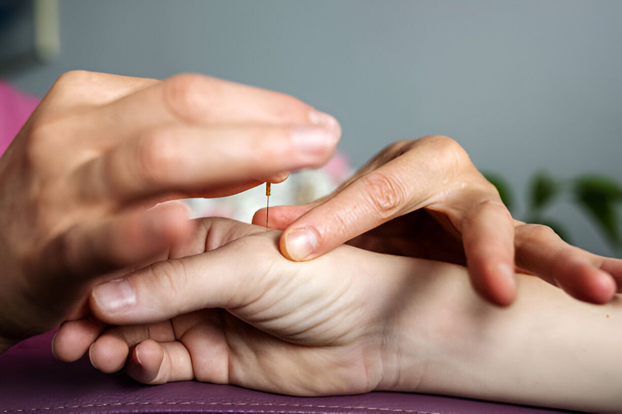 Putting an acupuncture needle in hand.